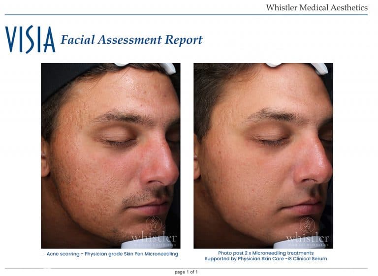 Acne-skinpen-before-and-after-copy-768x561