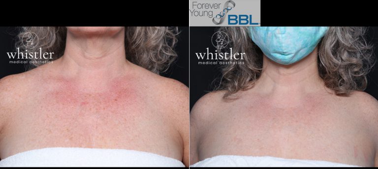 BBL-chest-before-and-after-websize-768x344