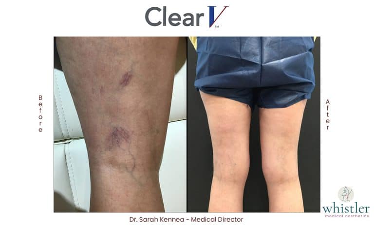 Clear-V-before-and-after-2-768x468