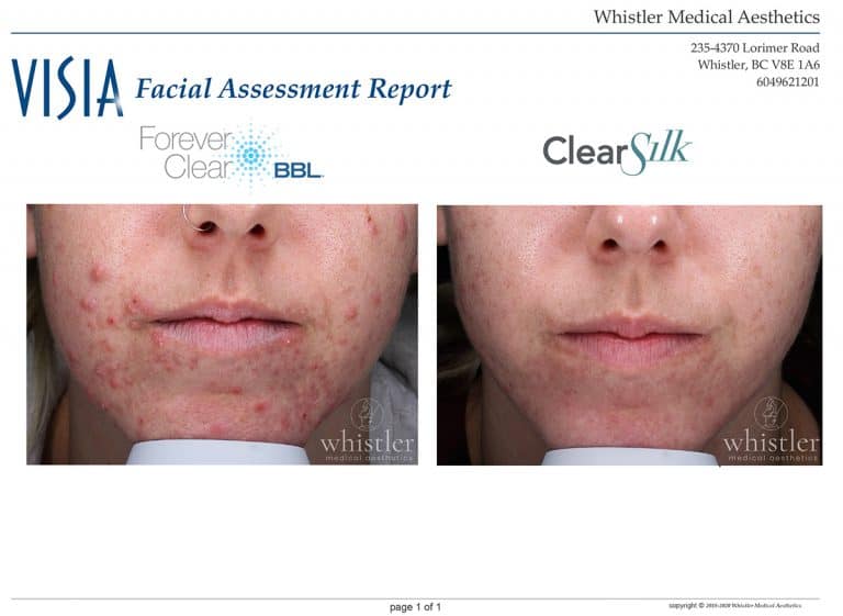 Forever-Clear-before-and-after-websize-768x561