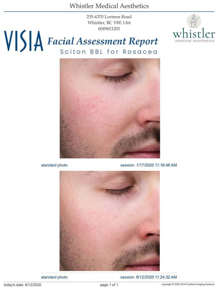 Male-Rosacea-BBL-side-768x1011