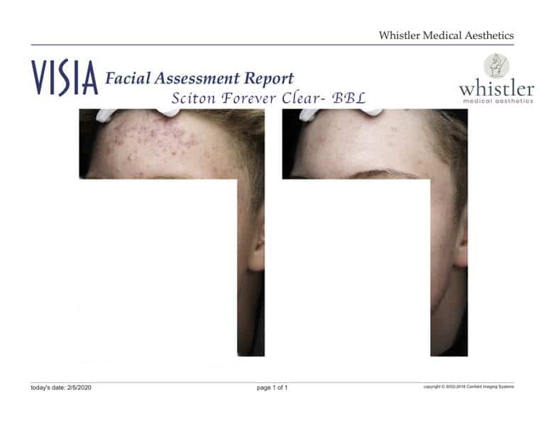 Male-acne-before-and-after-websize-768x593