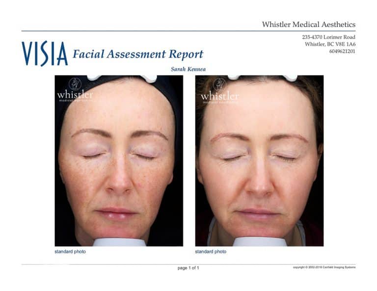 Sarah-Halo-before-and-after-front-normal-copy-768x593