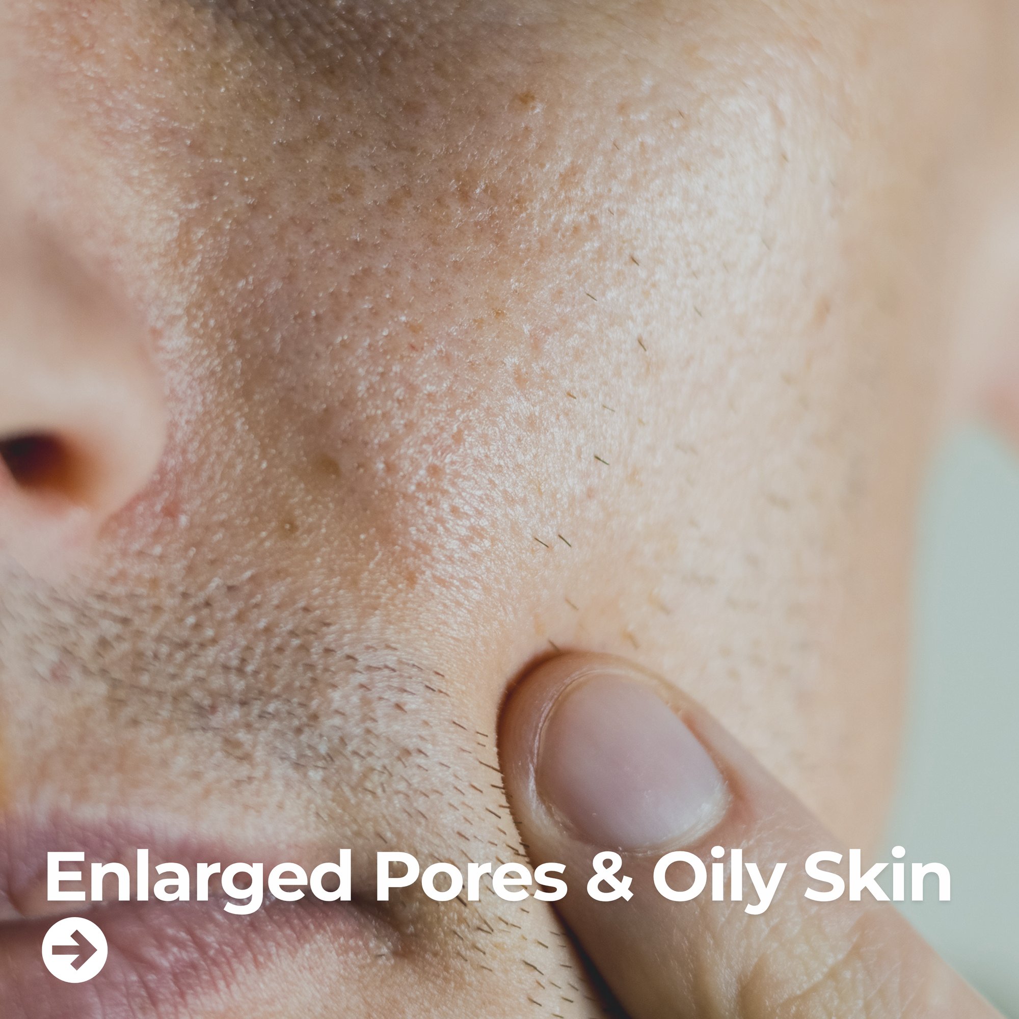 Enlarged Pores and Oily Skin