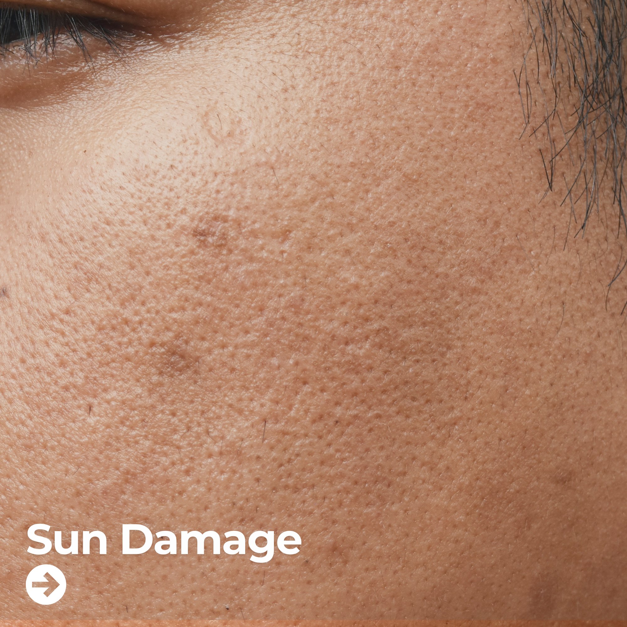Sun Damage