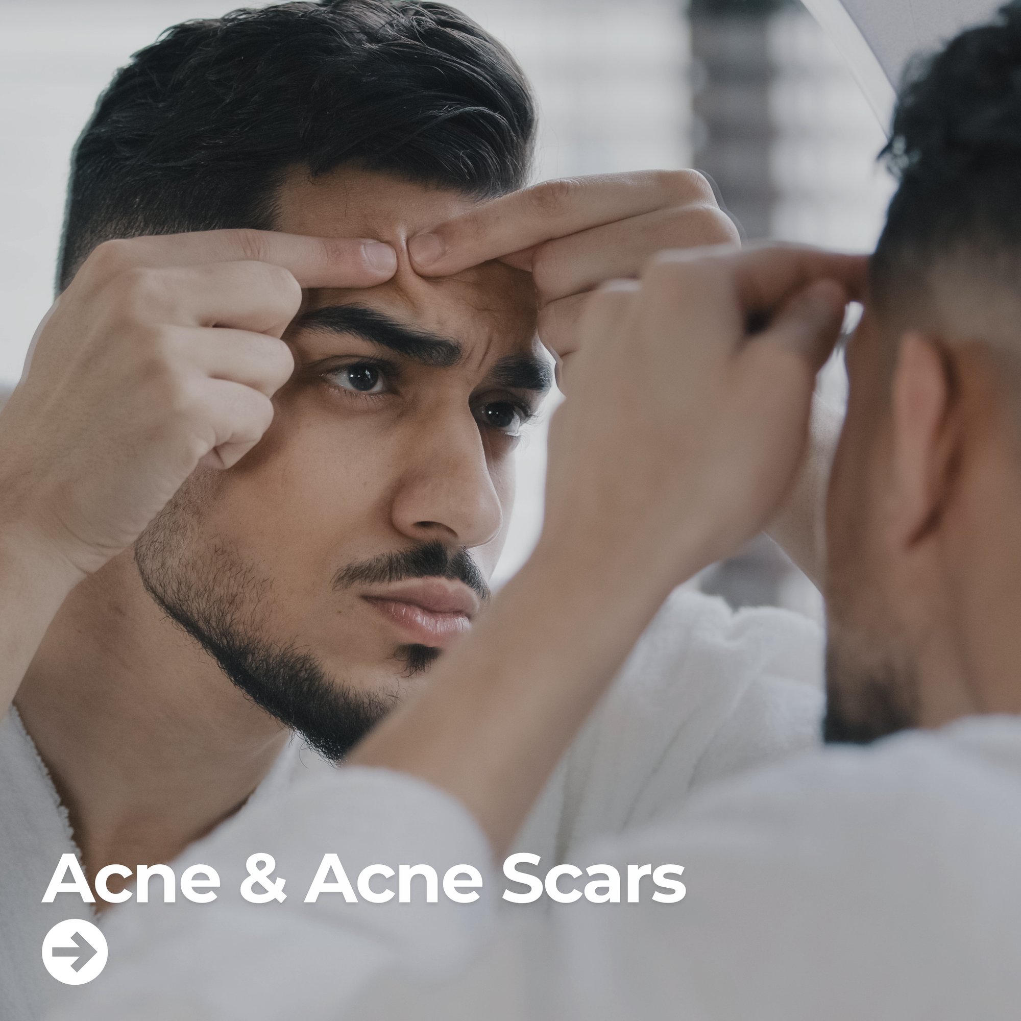 Acne & Acne Scars Acne & Acne Scars