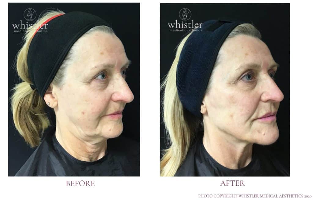 Bev Before after