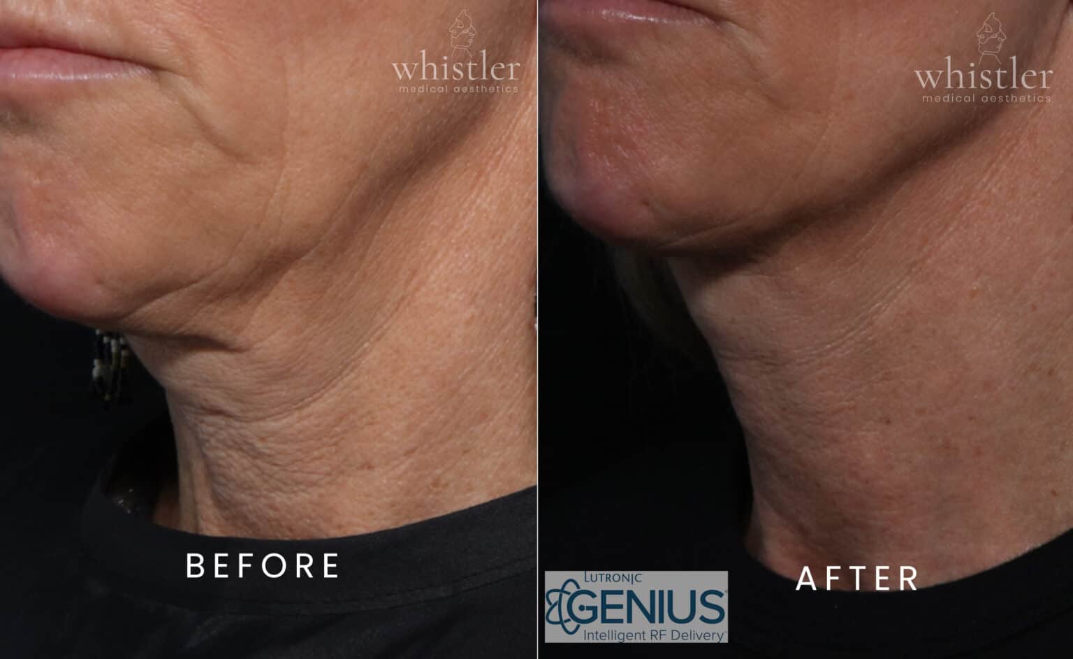 non surgical skin tightening with Genius