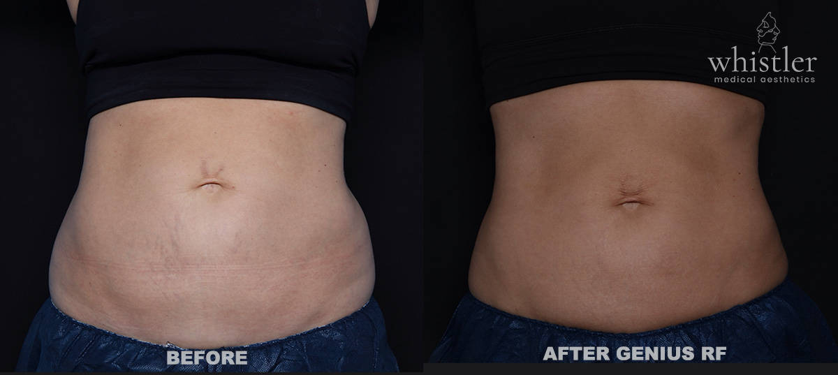 GENIUS-RF-BODY-STRETCH
