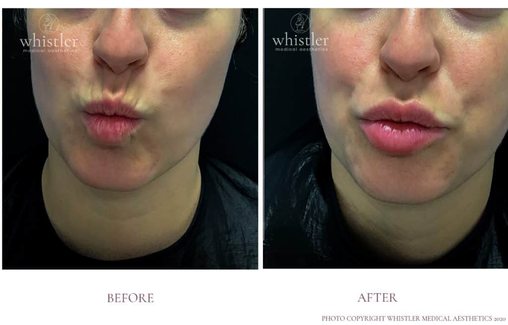 LIP LINES 2