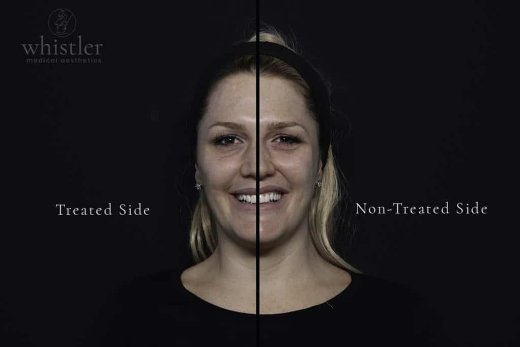 Photograph taken at midway point, where only half the face has been treated.