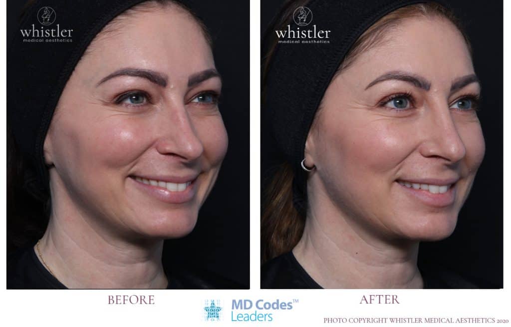 Lower face restoration of volume and non surgical nose correction