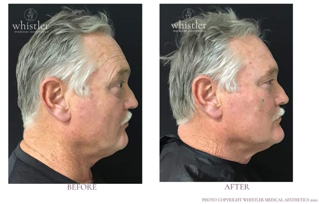 Male full soft lift