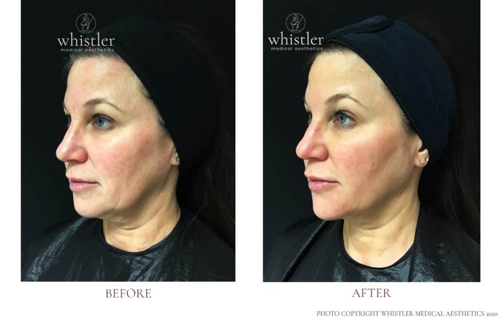 Juvederm Dermal Filler lift and shape