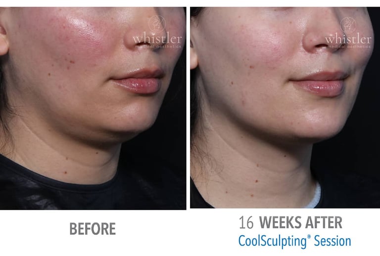 Coolsculpting Before
