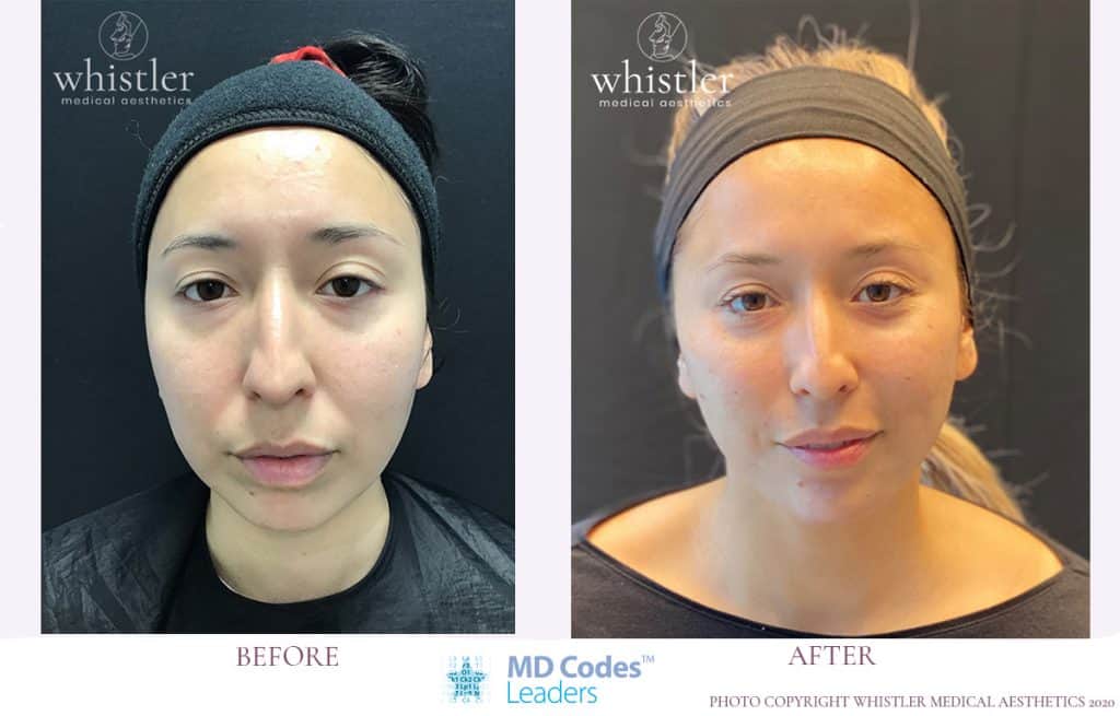 Soft Lift and Shape