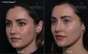 7 point shape female before and after