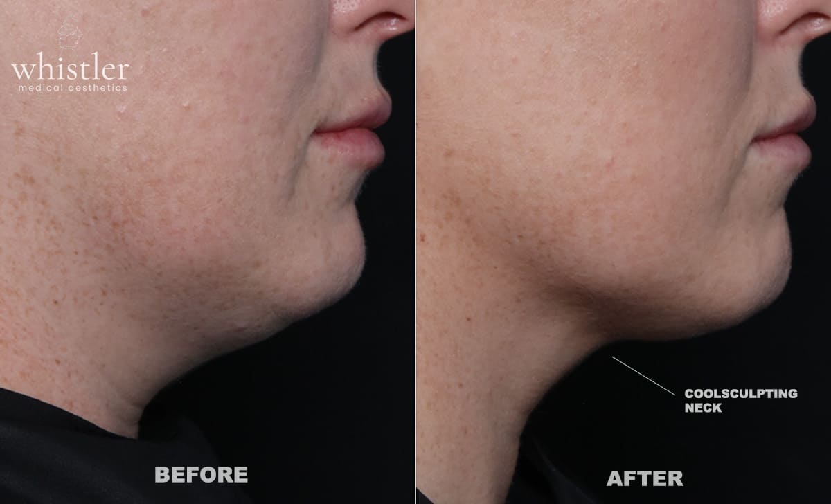 Coolsculpting Under Chin – The Transformative Power of to banish Under Chin Submental Fat