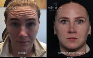 BOTOX FOREHEAD