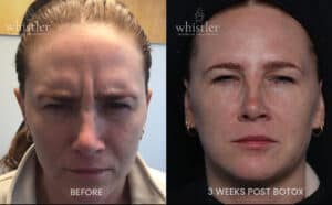 BOTOX-SQUINT-BEFORE-AFTER-300x186 (1)
