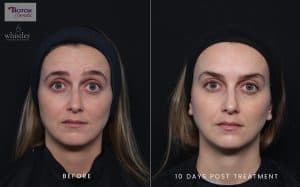 Botox Female Websized Before after