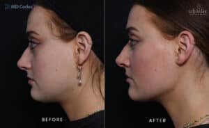Female Jawline Side before and after