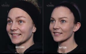 Female side 45 under eyes 2022 march