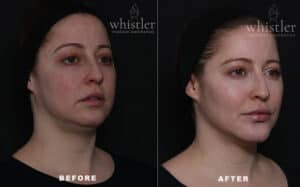 Full Face before and after CONTOUR MD Codes April 2023