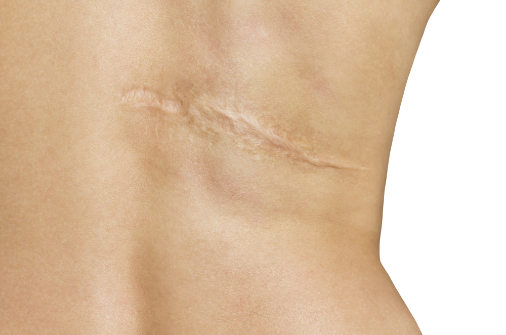 aspireMD - SCAR MINIMIZING RESURFACING LASER