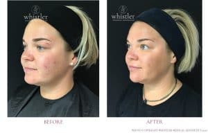Bev Before after