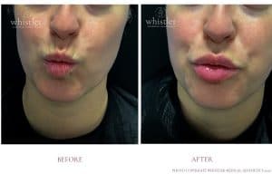 LIP LINES 2