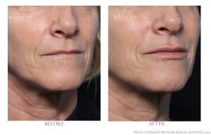 LIPS ENHANCEMENT