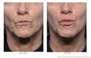 LIPS Lines