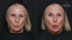 Linda Kiss before after
