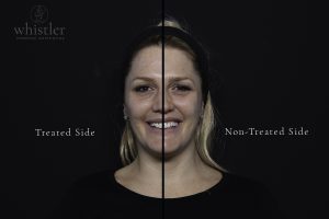 Linsey line split before after