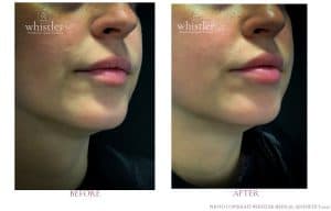 Lips 10