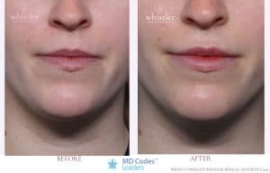Lips with Dermal Fillers