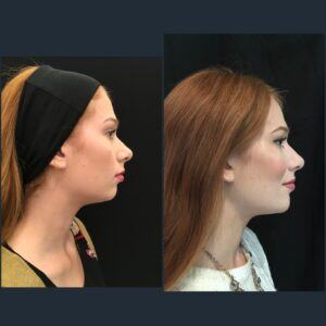 MJ right 45 before and after chin