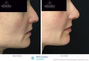 Non surgical Nose correction