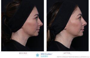 Non surgical nose side angle