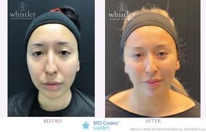 Silke before and after