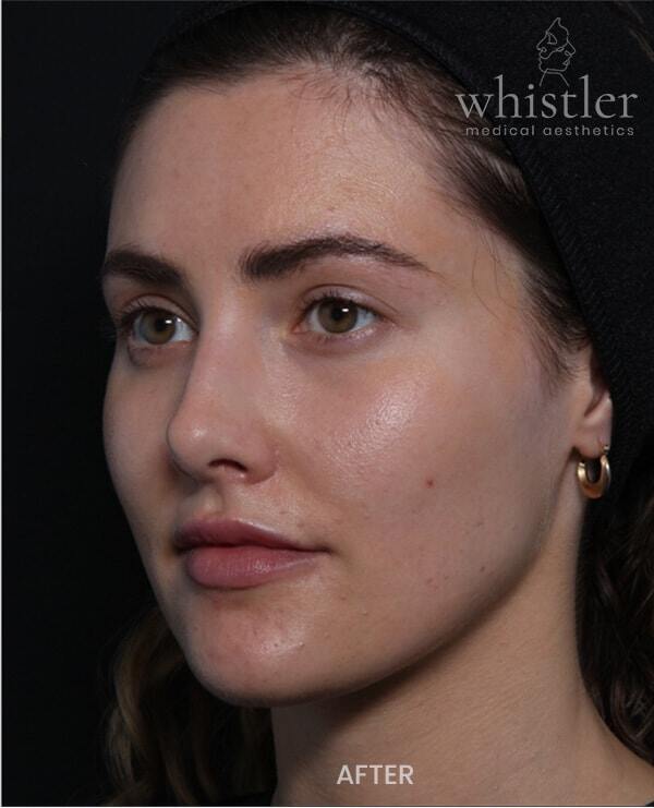 Genius Microneedling patient before treatment