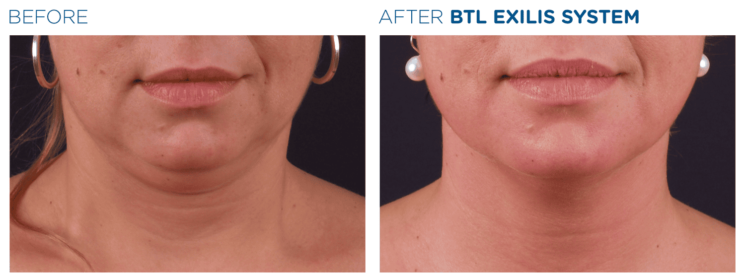 【極美品】Non-Surgical Skin Tightening and Li What Are The Best Non-surgical Skin Tightening Treatments