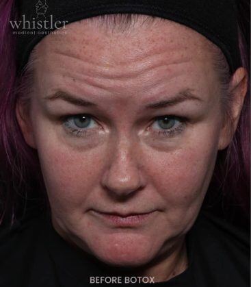 before treatment