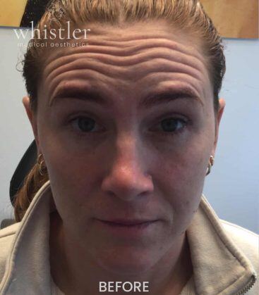 before treatment