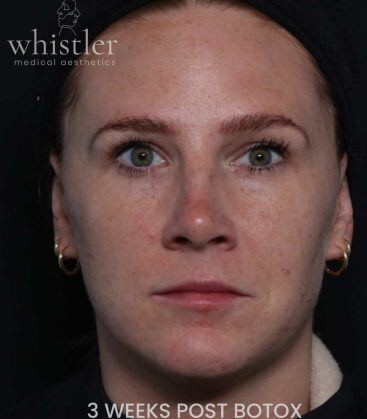 Genius Microneedling patient before treatment