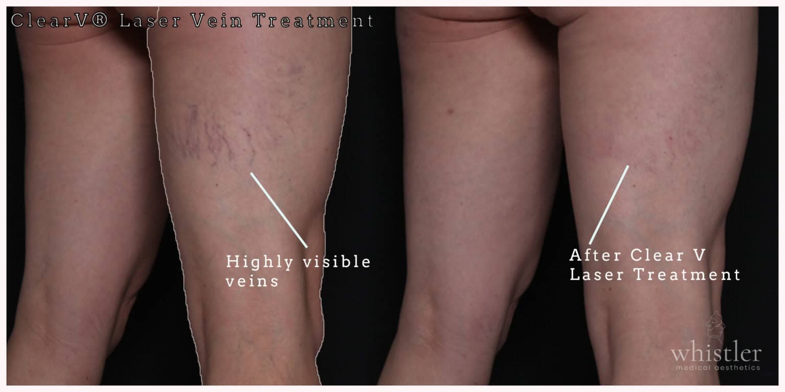 How Clear V Laser Can Transform Your Summer: Say Goodbye to Unsightly Leg Veins