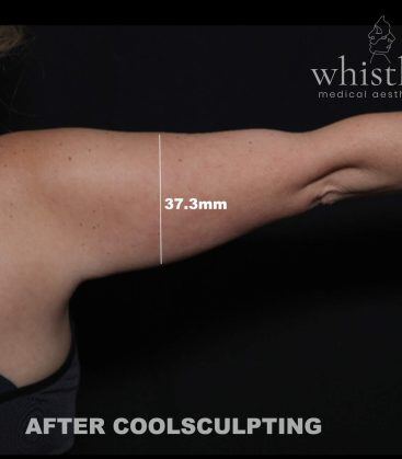 Genius Microneedling patient before treatment