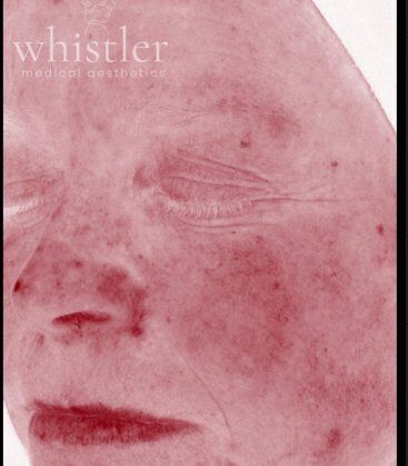 Genius Microneedling patient before treatment
