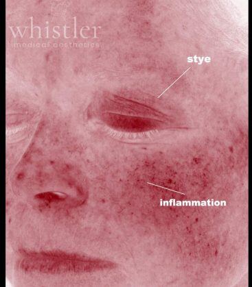 before treatment